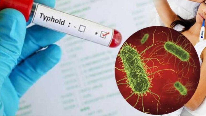 Typhoid fever